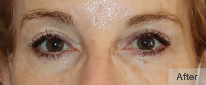 Close-up of a person's eyes after treatment showing improvement | Dr. Rodger Davies