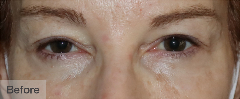 Close-up of a person's eyes before treatment showing puffiness | Dr. Rodger Davies