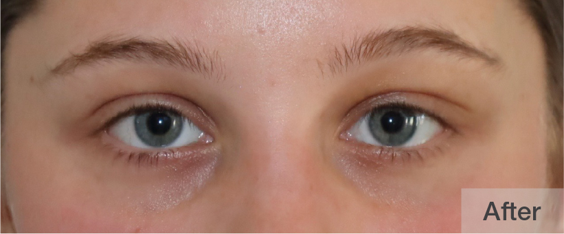 Close-up of a young woman's eyes after treatment showing refreshed appearance | Dr. Rodger Davies