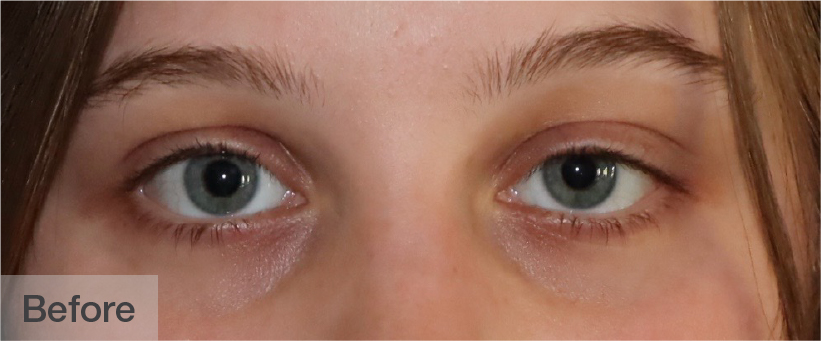 Close-up of a young woman's eyes before treatment showing tired appearance | Dr. Rodger Davies
