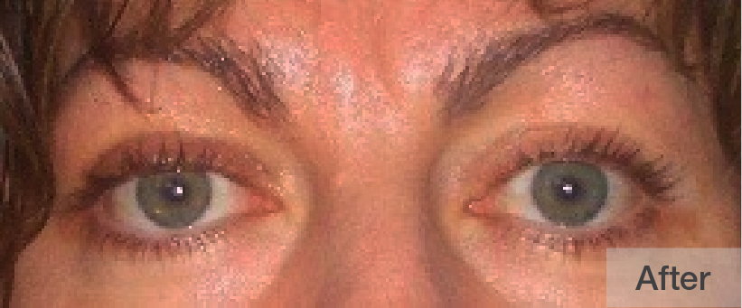 Close-up of a person's eyes after treatment showing refreshed look | Dr. Rodger Davies