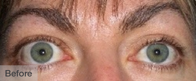 Close-up of a person's eyes before treatment showing tired appearance | Dr. Rodger Davies