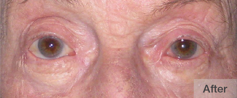 Close-up of a person's eyes after treatment showing reduced puffiness | Dr. Rodger Davies