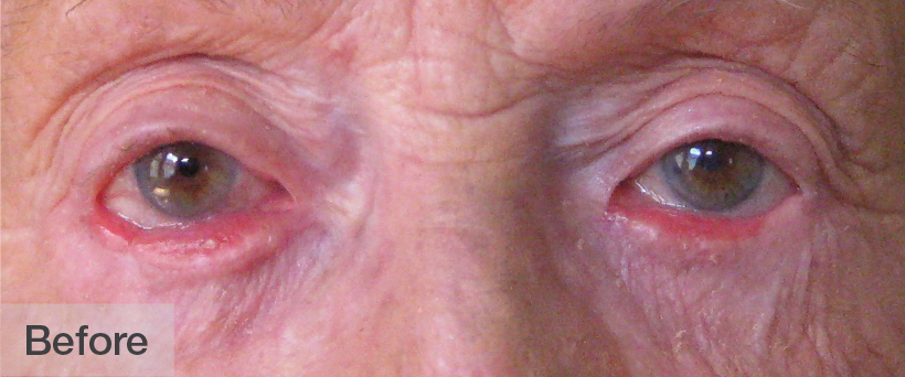 Close-up of a person's eyes before treatment showing redness and puffiness | Dr. Rodger Davies