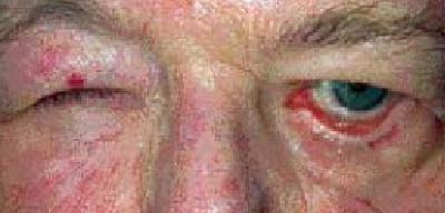Close-up of a person's eye with redness and swelling near the eyelid | Dr. Rodger Davies