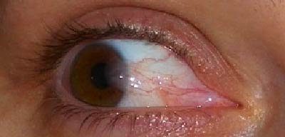 Close-up of an eye with a white area indicating possible irritation or infection | Dr. Rodger Davies