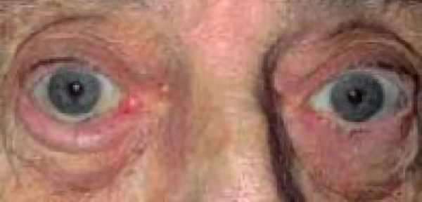 Close-up of a person's eyes showing redness and swelling near the eyelids | Dr. Rodger Davies