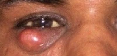 Close-up of a person's eye with a swollen bump near the eyelid | Dr. Rodger Davies