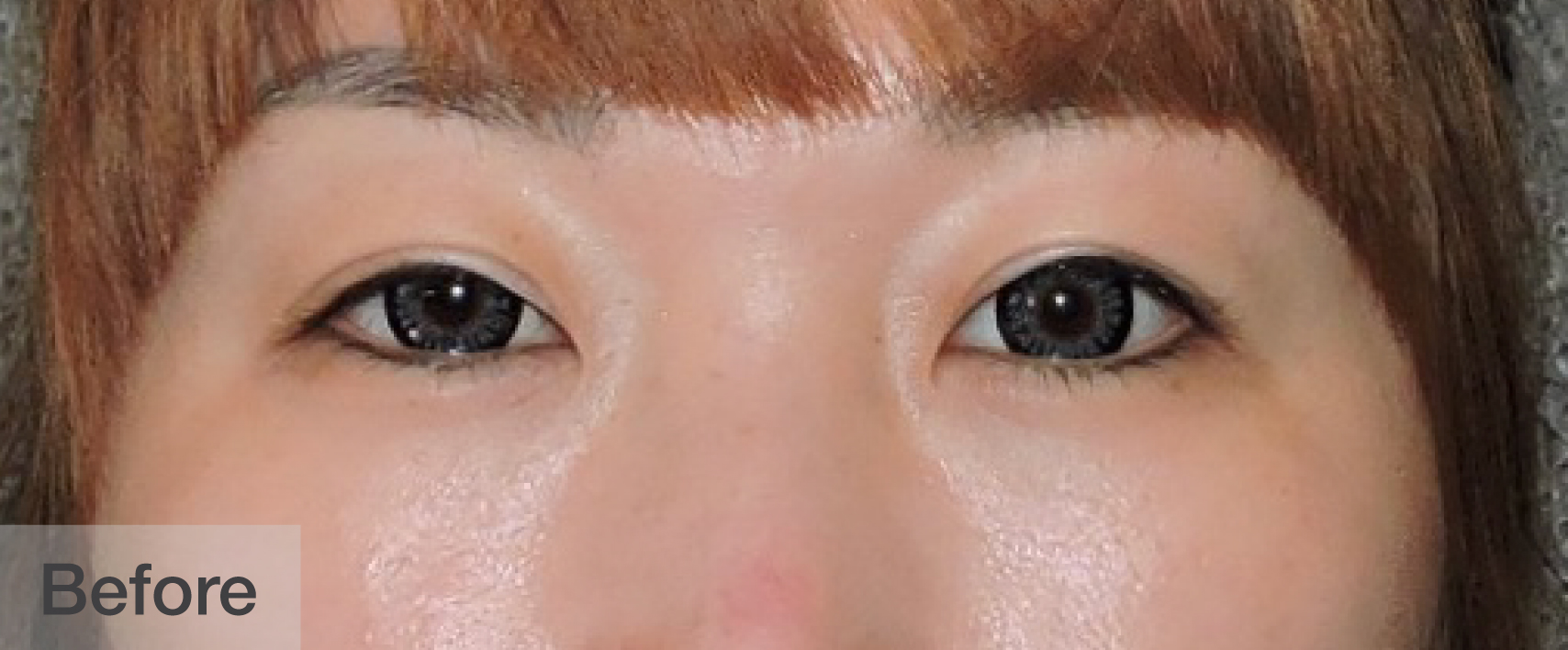 Close-up of a woman's eyes before eyelash enhancement showing natural lashes | Dr. Rodger Davies