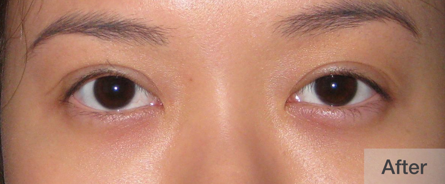 Close-up of a woman's eyes after eyelash enhancement showing fuller lashes | Dr. Rodger Davies
