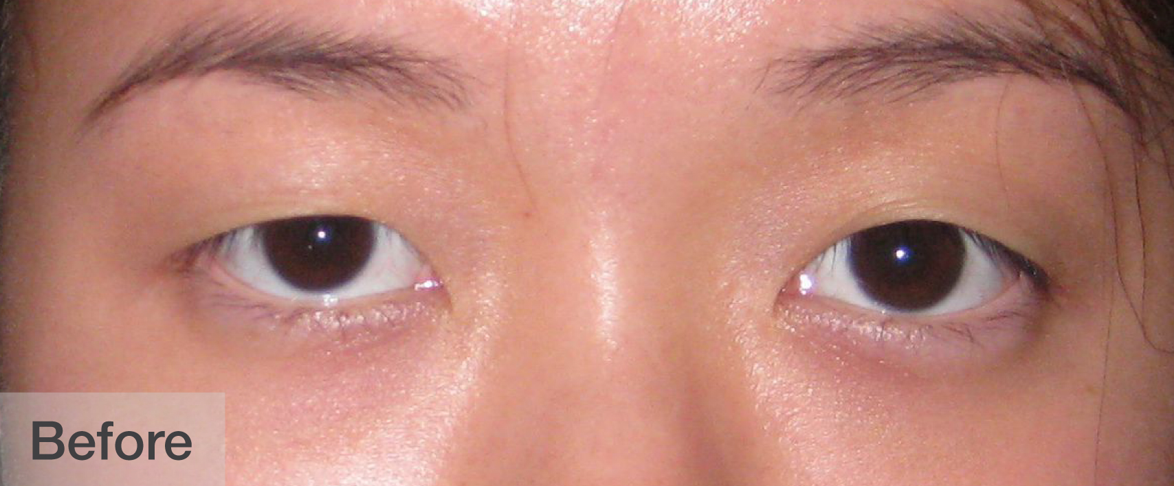 Close-up of a woman's eyes before eyelash enhancement showing natural lashes | Dr. Rodger Davies