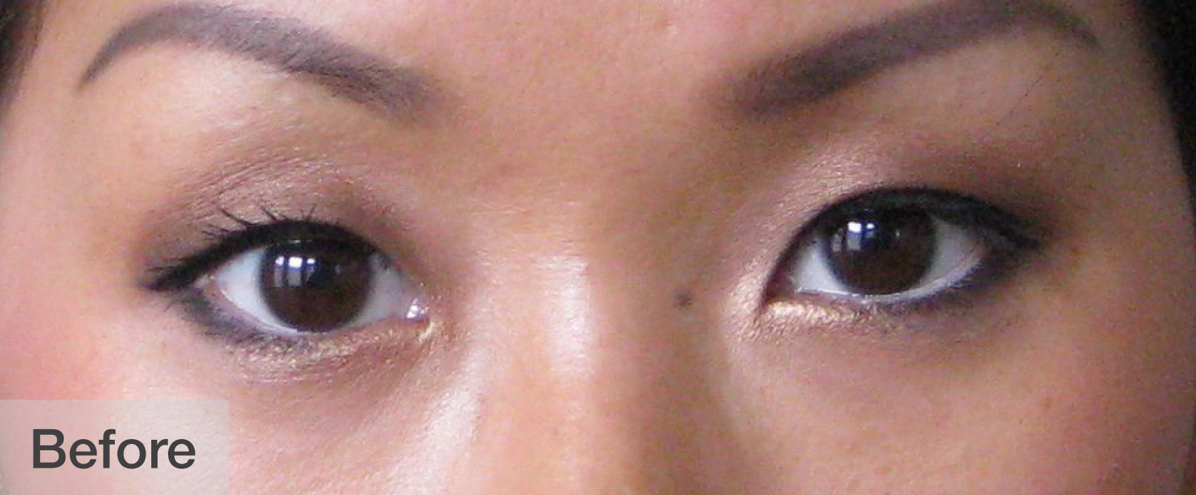 Before double eyelid surgery showing natural, hooded eyelids | Dr. Rodger Davies