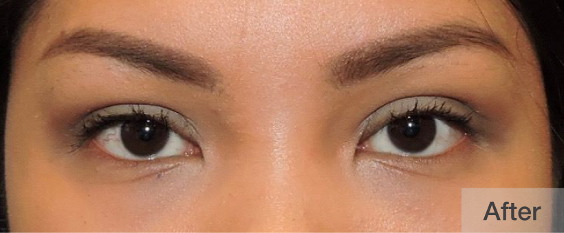 After double eyelid surgery showing enhanced, defined eyelids | Dr. Rodger Davies