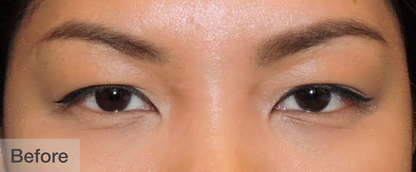 Before double eyelid surgery showing the natural eyelid shape | Dr. Rodger Davies