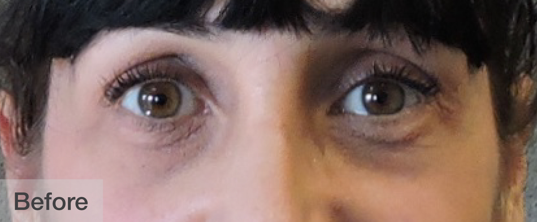 Before double eyelid surgery showing eyes with natural lashes | Dr. Rodger Davies