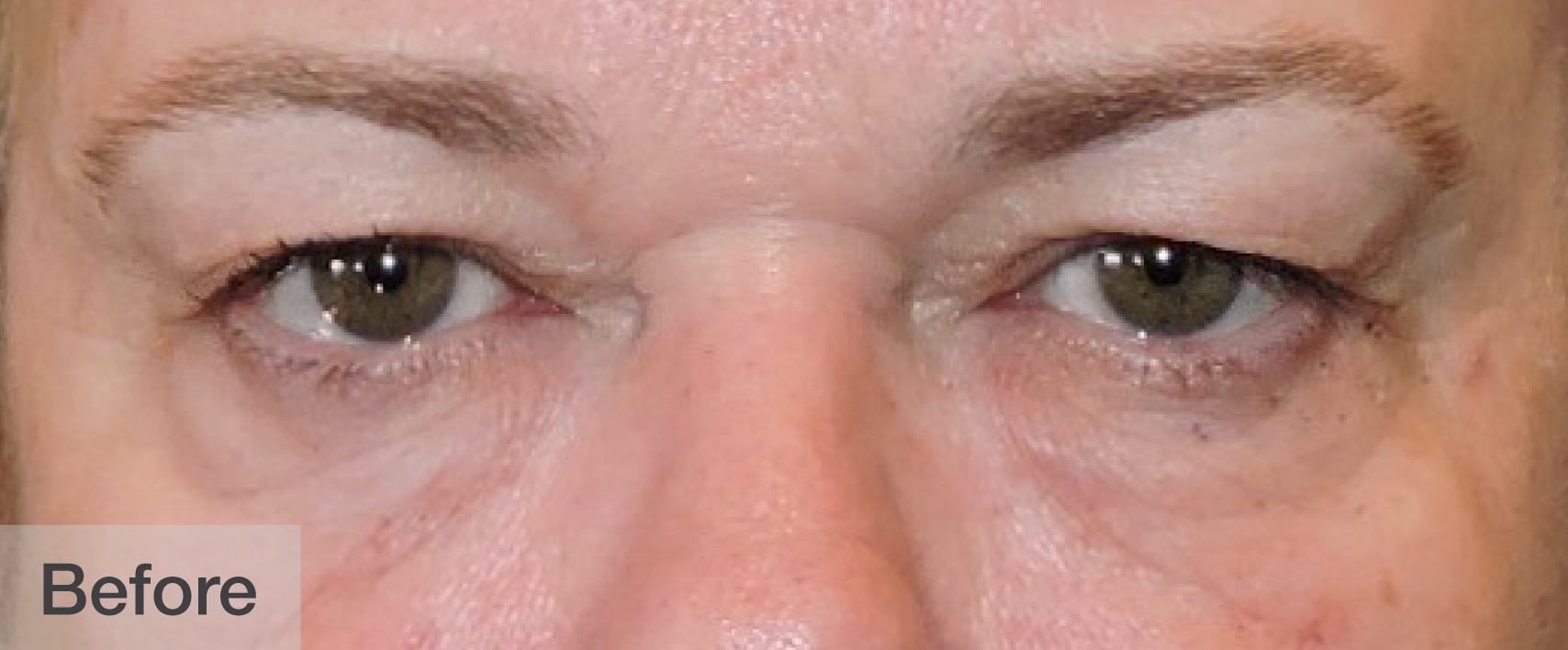 Before double eyelid surgery showing eyes and natural brows | Dr. Rodger Davies