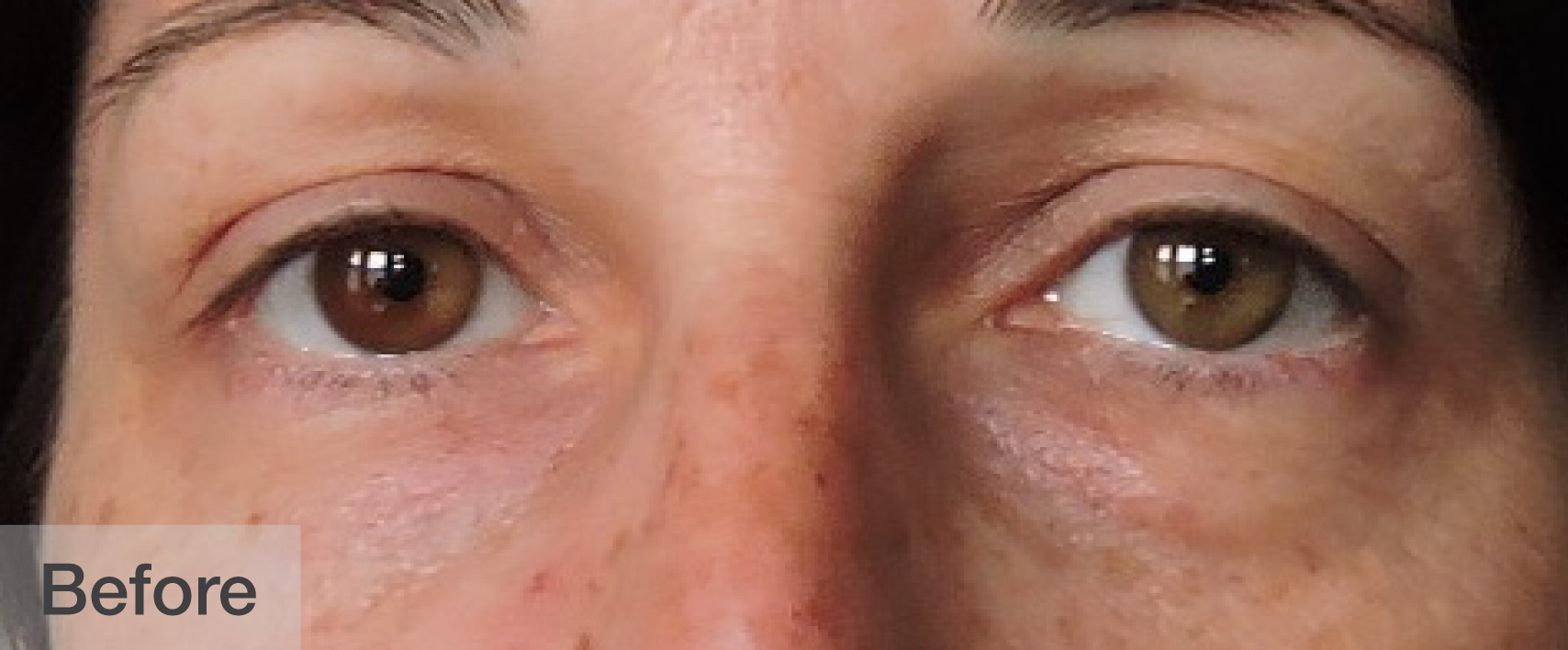 Before double eyelid surgery showing natural eyes and brows | Dr. Rodger Davies