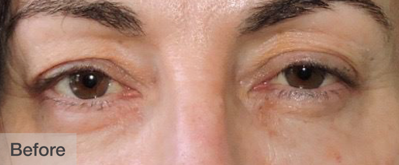 Before double eyelid surgery showing natural eyes and slight puffiness | Dr. Rodger Davies