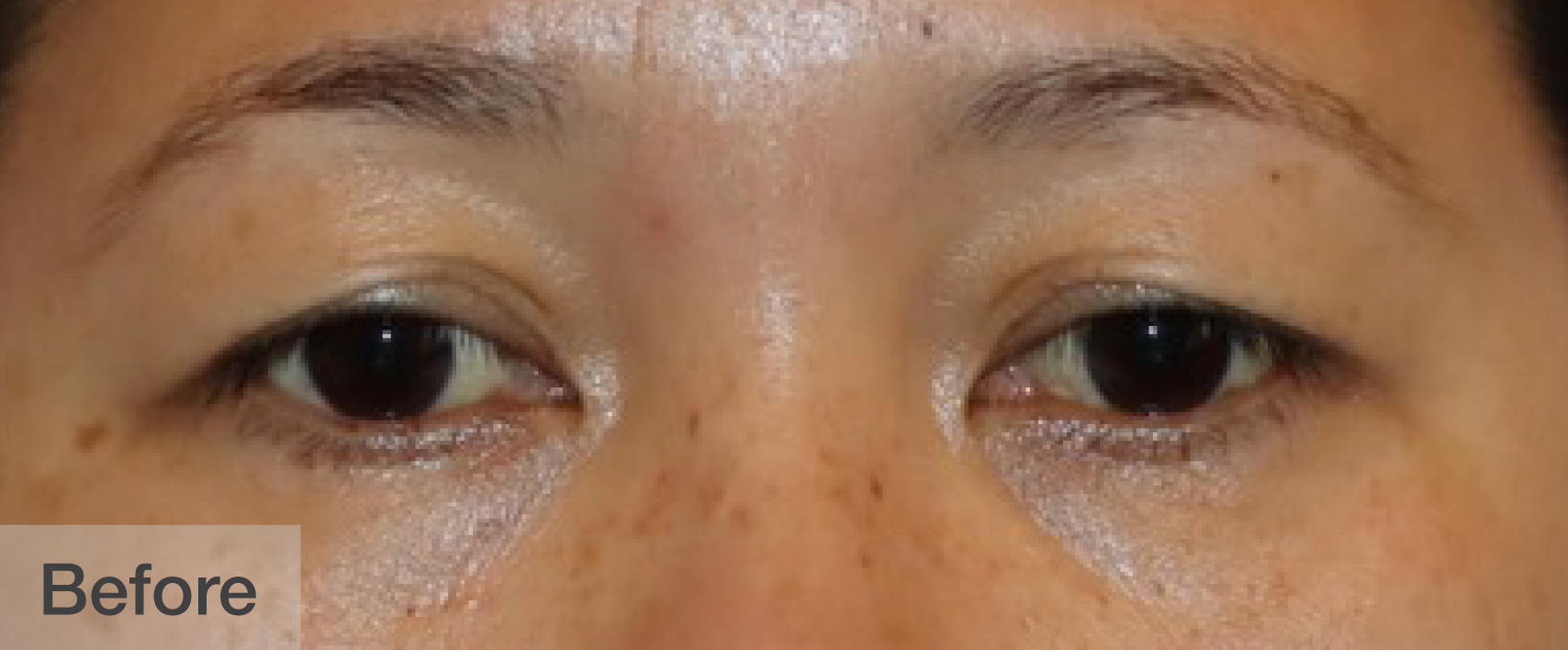 Before double eyelid surgery showing natural eyes with slight puffiness | Dr. Rodger Davies