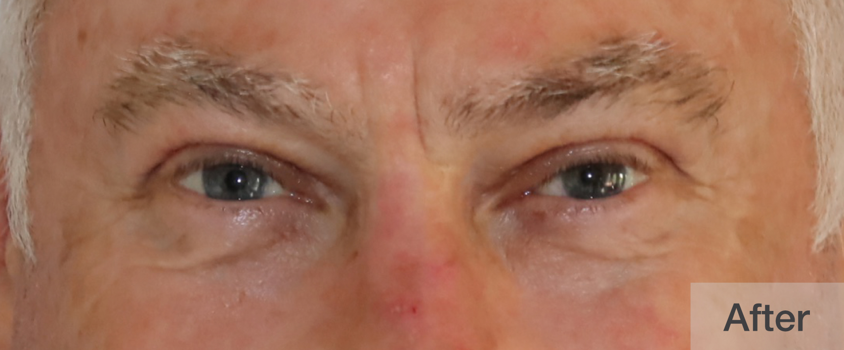 After double eyelid surgery showing smoother upper lids | Dr. Rodger Davies