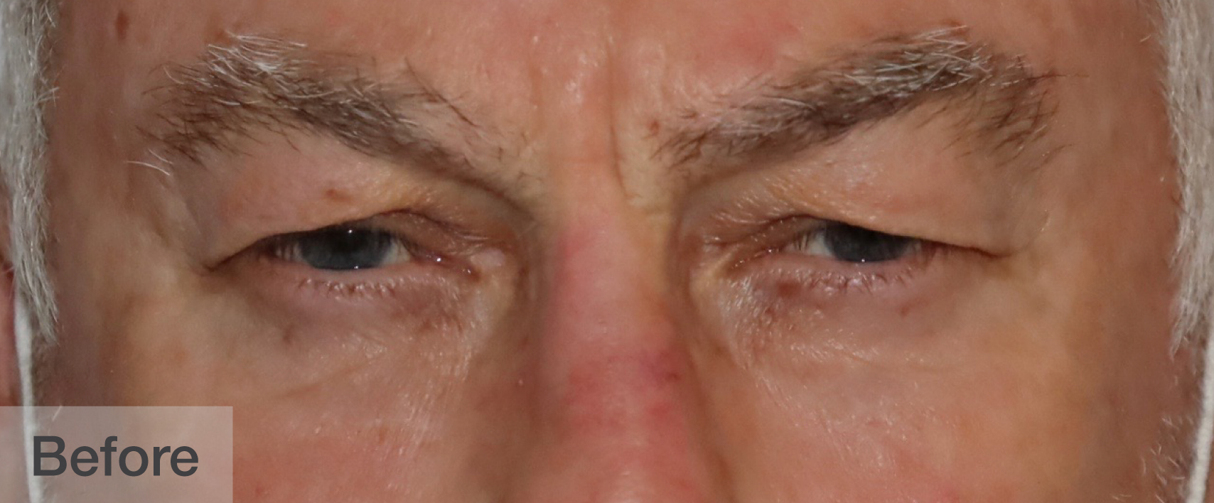 Before image showing close-up of a person's eyes and eyebrows | Dr. Rodger Davies