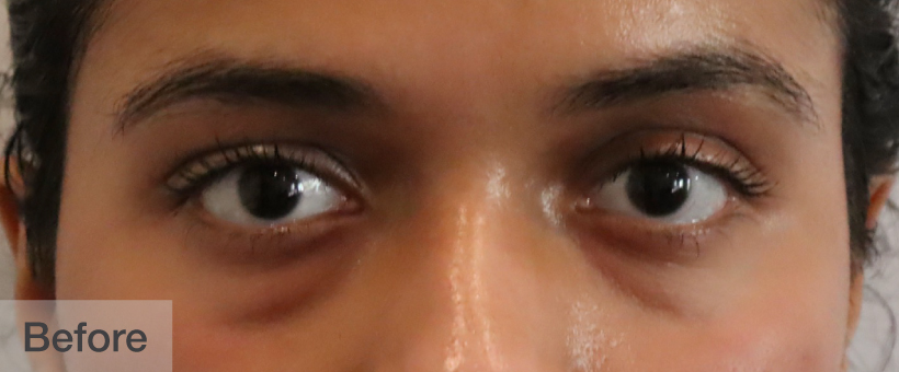 Before image showing close-up of a person's eyes and eyebrows | Dr. Rodger Davies