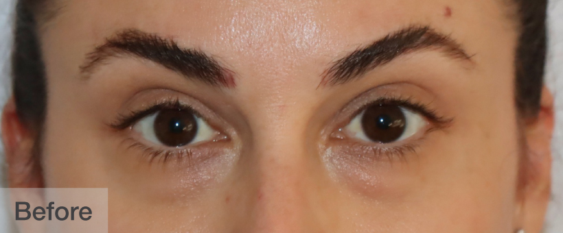 Before image showing close-up of a person's eyes and eyebrows | Dr. Rodger Davies