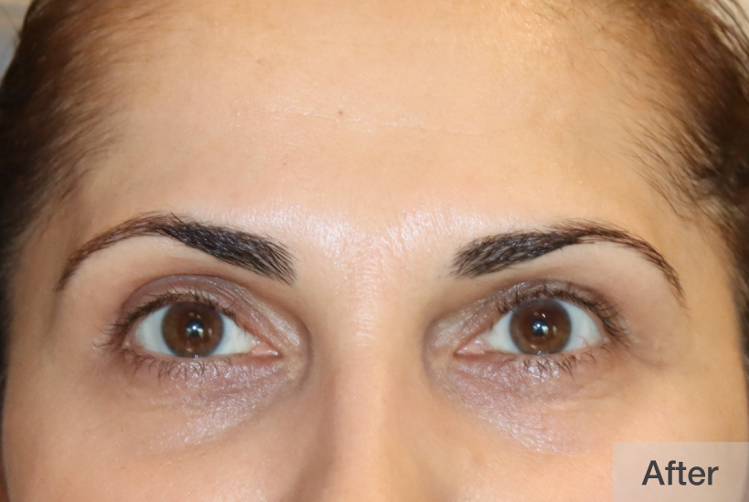 After image showing close-up of a person's eyes and eyebrows | Dr. Rodger Davies