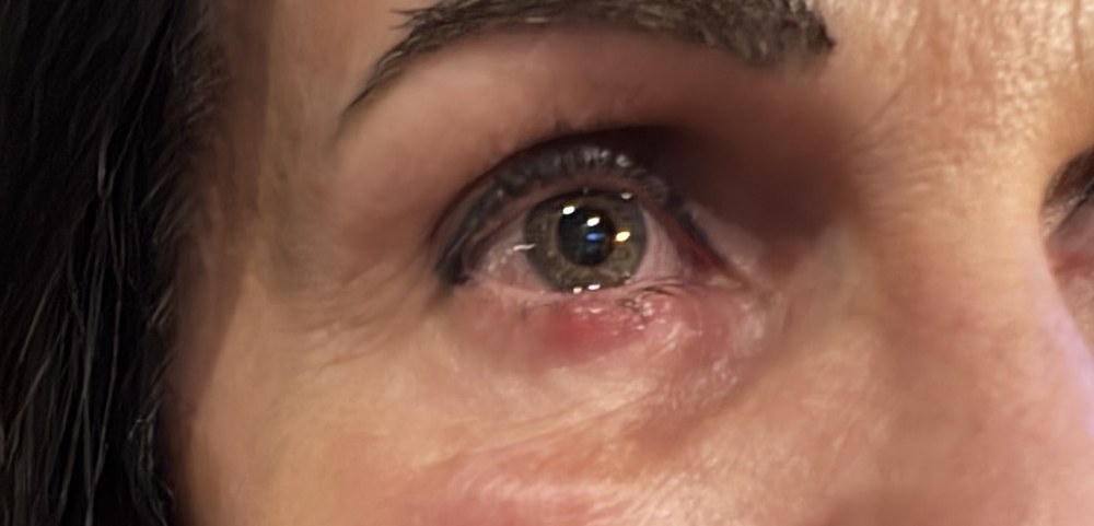 Close-up of an eye showing lower eyelid swelling and redness | Dr Rodger Davies