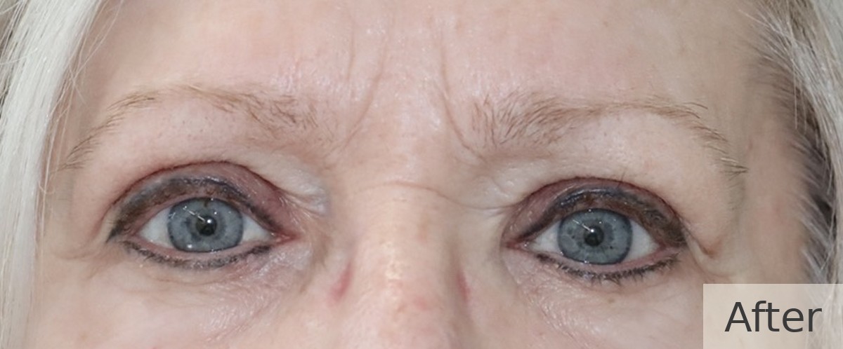 Bilateral ptosis (droopy upper eyelid) repair — after, Dr Rodger Davies oculoplastic surgeon Melbourne