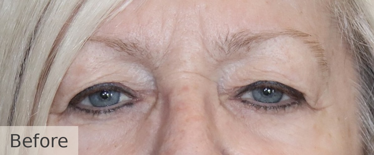 Bilateral ptosis (droopy upper eyelid) repair — before, Dr Rodger Davies oculoplastic surgeon Melbourne