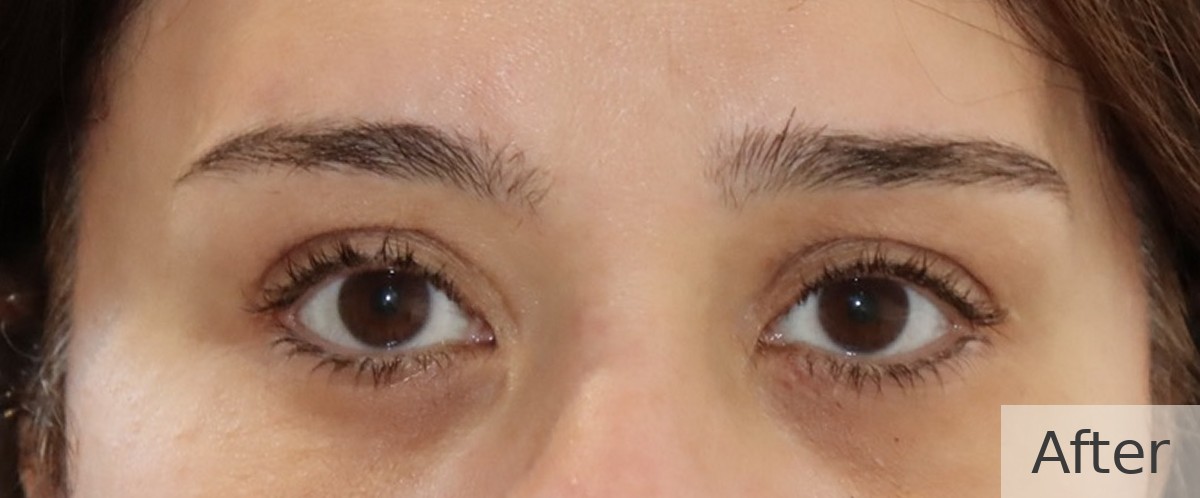 Ptosis repair with endoscopic brow lift — after, Dr Rodger Davies oculoplastic surgeon Melbourne