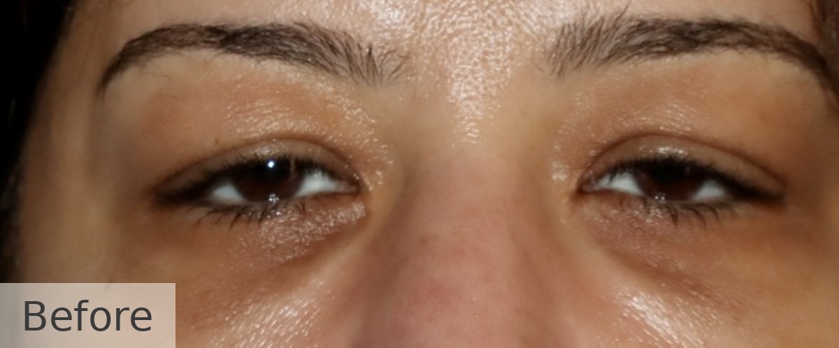 Ptosis repair with endoscopic brow lift — before, Dr Rodger Davies oculoplastic surgeon Melbourne