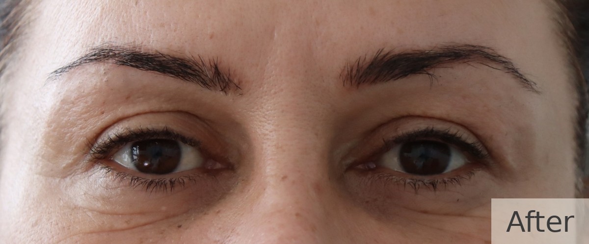 Ptosis correction with upper blepharoplasty — after, Dr Rodger Davies oculoplastic surgeon Melbourne