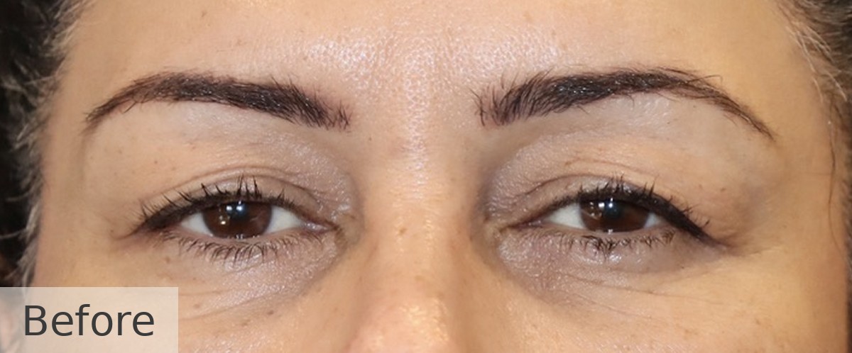 Ptosis correction with upper blepharoplasty — before, Dr Rodger Davies oculoplastic surgeon Melbourne