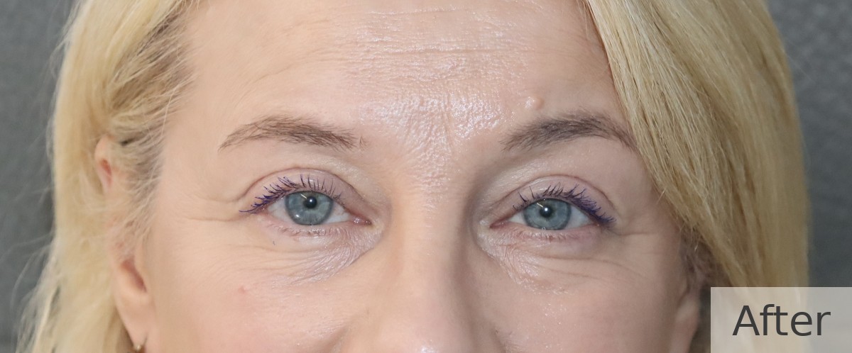 Ptosis correction with upper blepharoplasty — after, Dr Rodger Davies oculoplastic surgeon Melbourne