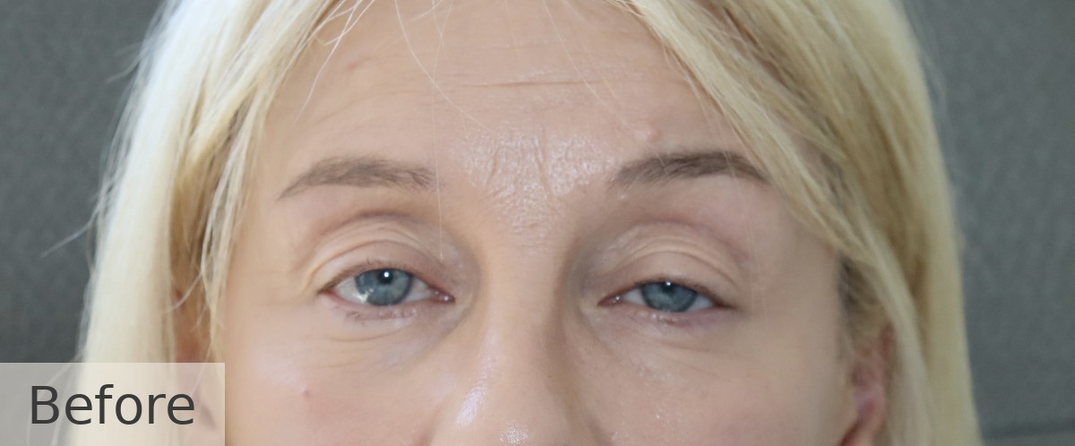 Ptosis correction with upper blepharoplasty — before, Dr Rodger Davies oculoplastic surgeon Melbourne
