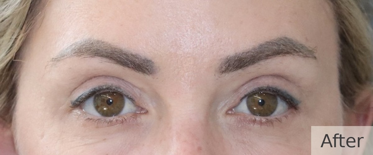 Upper blepharoplasty (upper eyelid surgery) — after, Dr Rodger Davies oculoplastic surgeon Melbourne