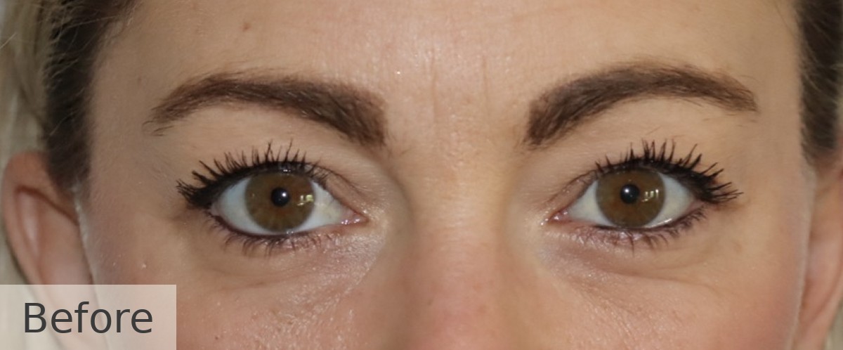 Upper blepharoplasty (upper eyelid surgery) — before, Dr Rodger Davies oculoplastic surgeon Melbourne